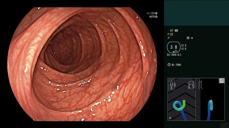 NewCa.com: Fujifilm launches ColoAssist PRO, a real-time endoscope - Vimarsana News
